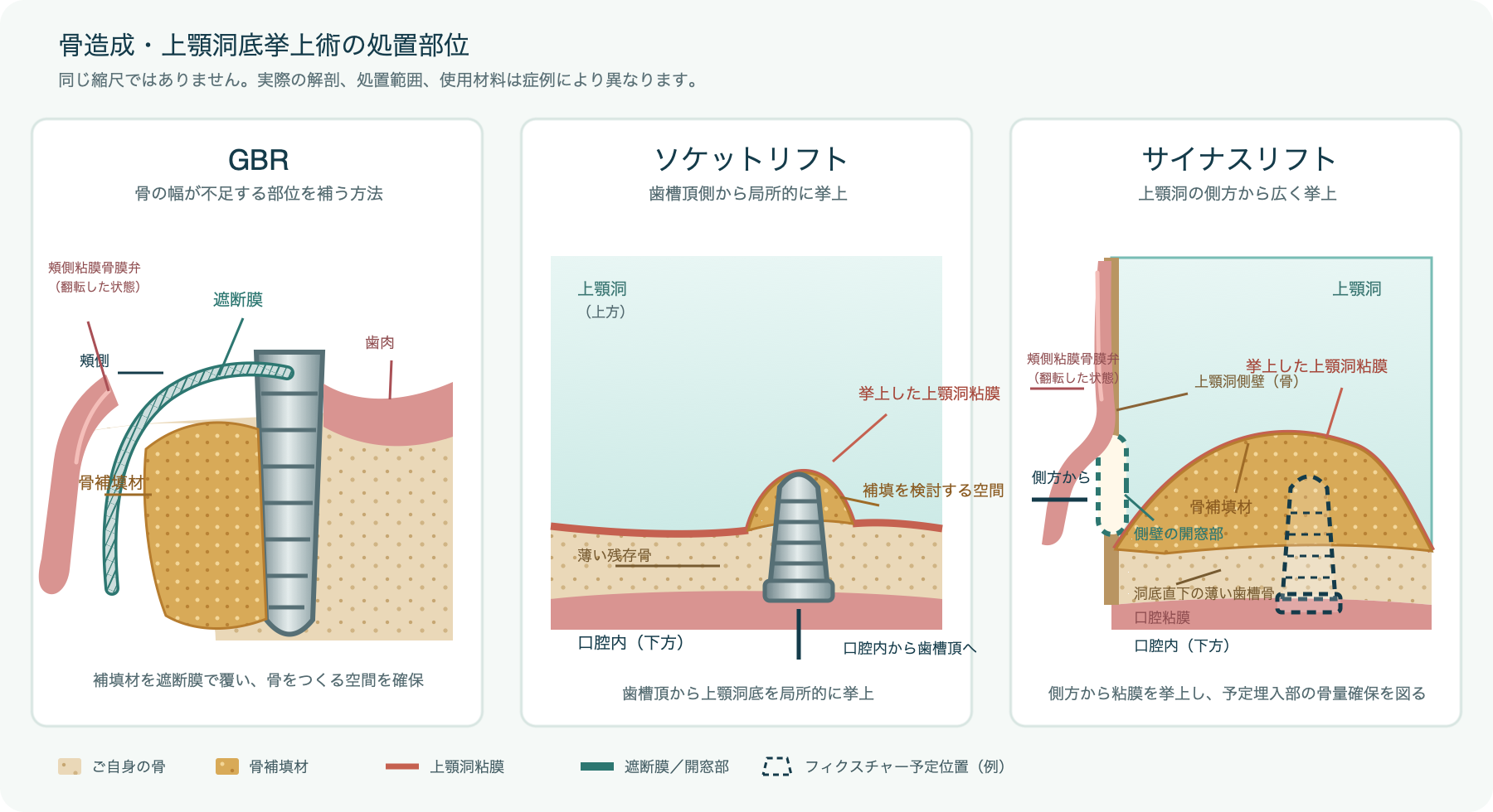 GBR、ソケットリフト、サイナスリフトを比較した模式図。GBRでは翻転した頬側粘膜骨膜弁、歯肉、遮断膜、骨補填材を示し、サイナスリフトでは頬側粘膜骨膜弁、上顎洞側壁の骨性開窓、挙上した上顎洞粘膜、洞底直下の薄い歯槽骨、口腔粘膜、将来のフィクスチャー予定位置を表示